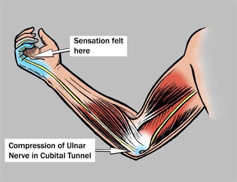 is cubital tunnel syndrome serious